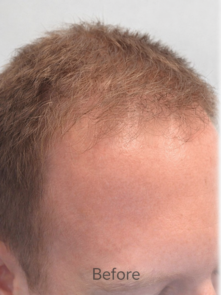 Before and after comparison of a person's hairline with 'Before' on the left and 'After' on the right.