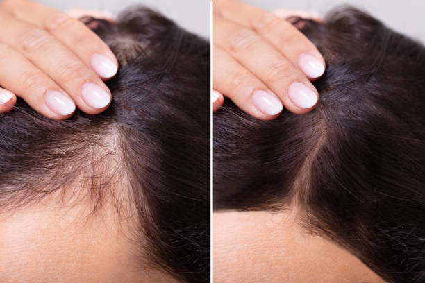 Side-by-side comparison of hair thickness on a person's scalp.